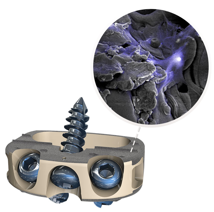 STALIF integrated interbody device with Ti-ACTIVE surface